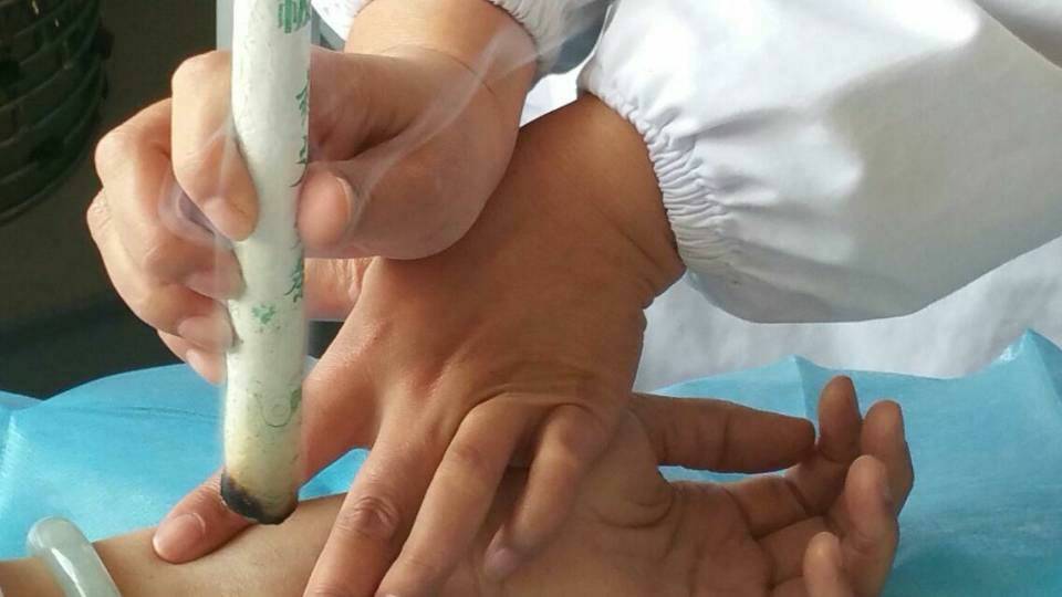 中醫(yī)特色護(hù)理小組 促進(jìn)示范工程深入開(kāi)展