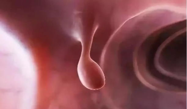 我叫息肉，是癌的近親！一封來自息肉的認罪書(圖1)