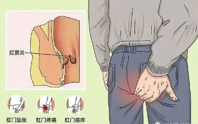 肛竇炎要當(dāng)心，它可讓人不省心！(圖2)