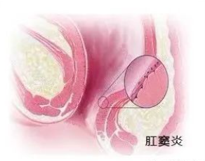 肛竇炎要當(dāng)心，它可讓人不省心！(圖3)