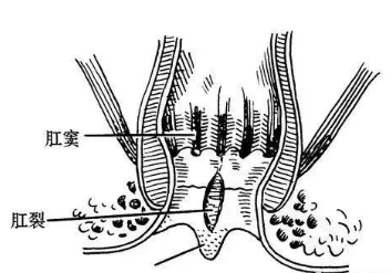 肛竇炎要當(dāng)心，它可讓人不省心！(圖4)