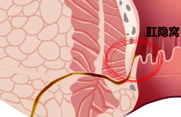 肛竇炎要當(dāng)心，它可讓人不省心！(圖5)