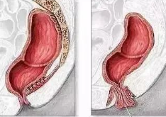 直腸脫垂危害重重，不可不防(圖2)